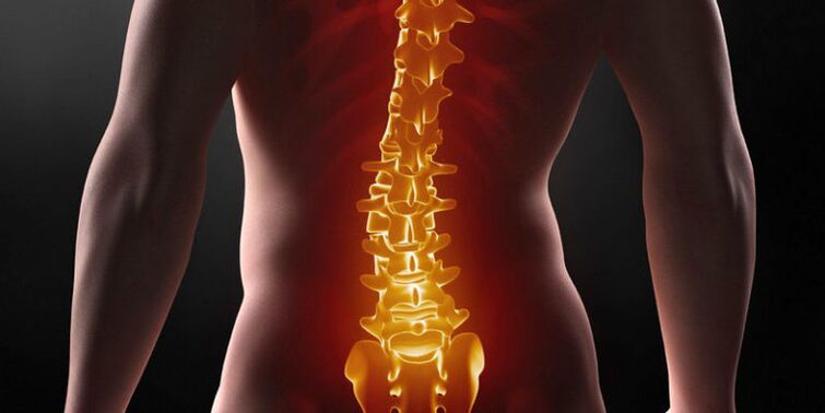 Sāpes muguras lejasdaļā - jostas daļas osteohondrozes III stadijas simptoms
