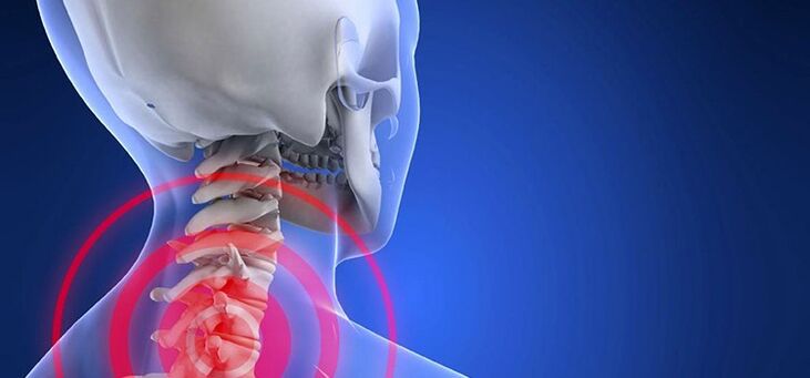 Dzemdes kakla mugurkaula osteohondroze